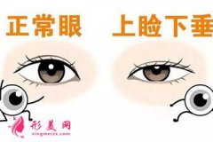 上瞼下垂矯正術(shù)怎么樣？矯正容貌美麗一生