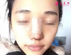 煙臺華怡整形醫(yī)院好么？隆鼻案例分享~