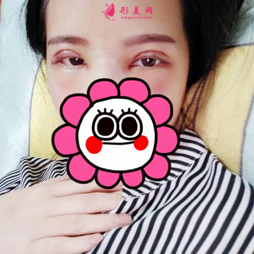 石家莊美聯(lián)臣怎么樣？雙眼皮案例
