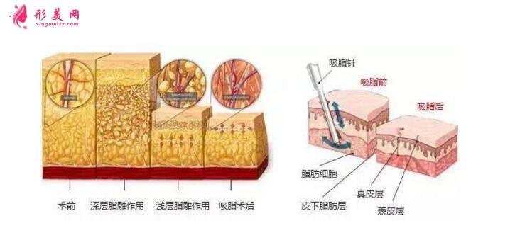 胳膊吸脂價(jià)格