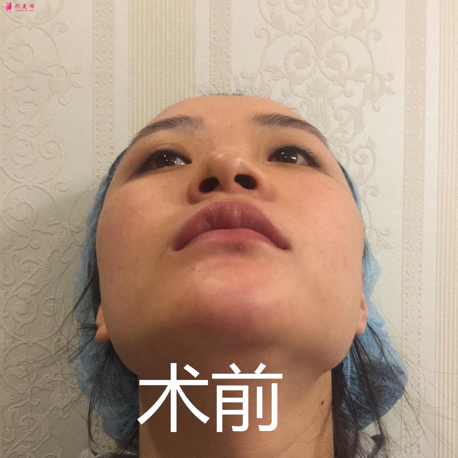 深圳赫思醫(yī)療美容怎么樣？價目表及網(wǎng)紅鼻整形案例