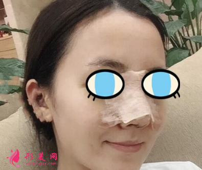武漢同濟(jì)整形王海平隆鼻怎么樣？前后60天對比圖 案例分享