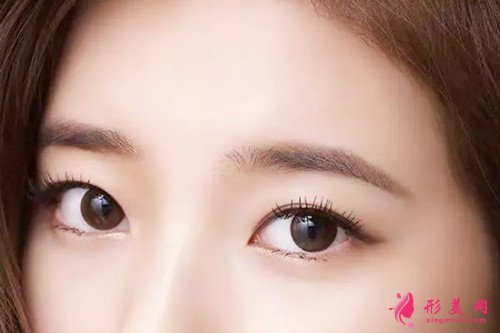 無痕開眼角要花費(fèi)多少錢