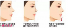 自體脂肪隆下巴效果怎么樣？缺點有哪些呢？