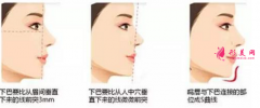 自體脂肪隆下巴效果怎么樣？缺點有哪些呢？