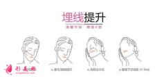 埋線面部提升是什么？效果好嗎？注意事項