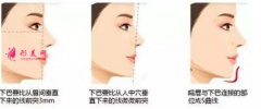 自體脂肪隆下巴效果怎么樣？缺點有哪些呢？