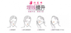 埋線面部提升是什么？效果好嗎？注意事項