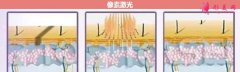 像素激光多少錢(qián)一次？術(shù)后注意事項(xiàng)有哪些？