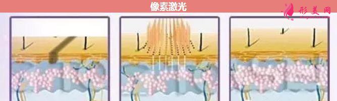 像素激光多少錢一次