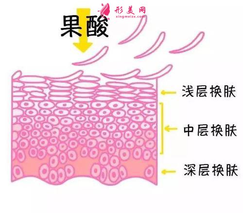 果酸換膚需要多少錢(qián)