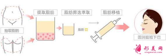 臉部自體脂肪填充價(jià)格