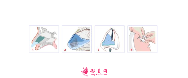 鼻骨縮小手術的難度