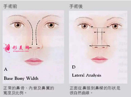 鼻骨縮小手術的難度