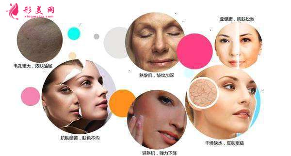 激光除皺手術效果