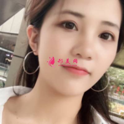找李曾顯醫(yī)生注射肉毒素去木偶紋手術(shù)后60天