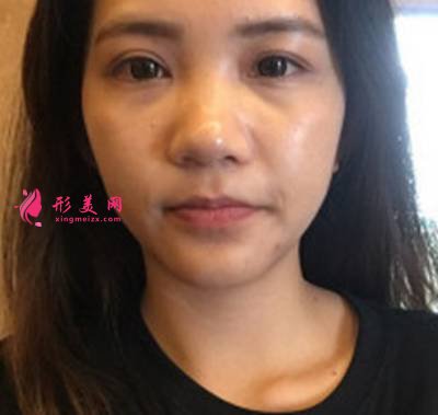 找李曾顯醫(yī)生注射肉毒素去木偶紋手術(shù)前