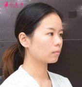 重慶好美找畢勝做鼻綜合整形手術(shù)，術(shù)后80天恢復(fù)效果圖