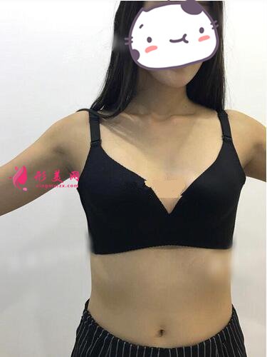 成都怡脂醫(yī)療美容醫(yī)院自體脂肪豐胸案例