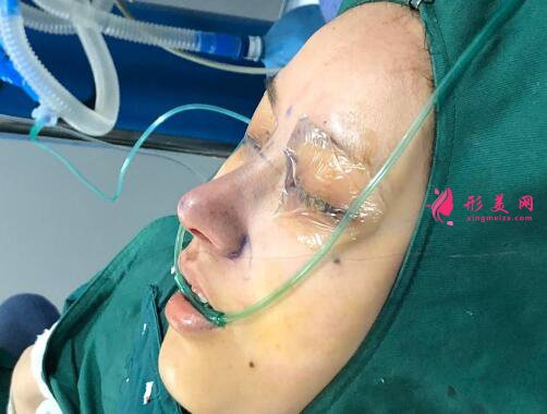 成都趙善軍博士整形美容門診部自體脂肪隆胸案例