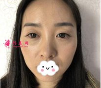 關(guān)于隆鼻的真實(shí)案例 相信很多朋友都在等我的分享