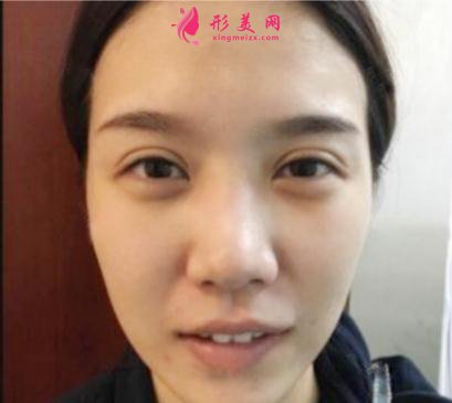 成都美立方整形醫(yī)院隆鼻案例 術后恢復效果反饋