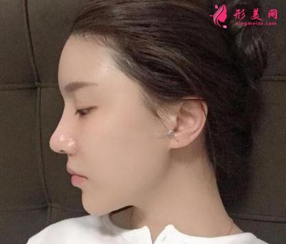 成都美立方整形醫(yī)院隆鼻案例 術后恢復效果反饋