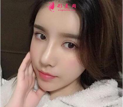 成都美立方整形醫(yī)院隆鼻案例 術后恢復效果反饋