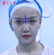 北京假體隆鼻怎么樣？隆鼻修復(fù)手術(shù)日記，鼻子的重生記錄!