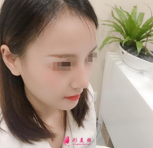 北京假體隆鼻修復(fù)手術(shù)日記，鼻子的重生記錄!