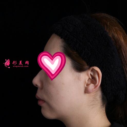 北大深圳醫(yī)院隆鼻案例圖錦集，塌鼻子兩個月逆襲初戀臉！