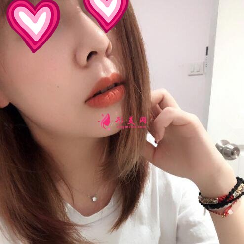 北大深圳醫(yī)院隆鼻案例圖錦集，塌鼻子兩個月逆襲初戀臉！