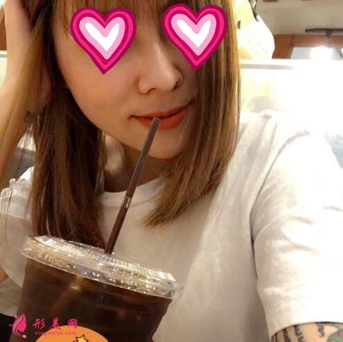 北大深圳醫(yī)院隆鼻案例圖錦集，塌鼻子兩個月逆襲初戀臉！
