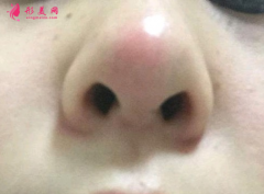 假體隆鼻后鼻尖發(fā)紅怎么回事？