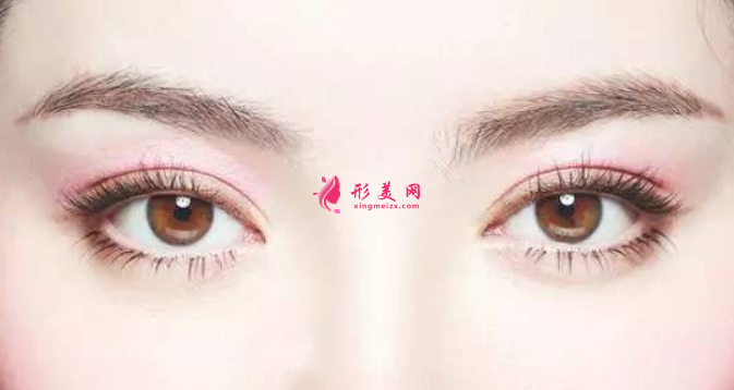 割雙眼皮常見的危害有什么