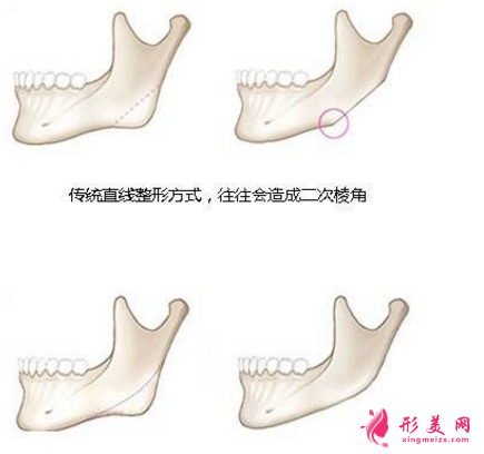 下頜角切除一般多少錢