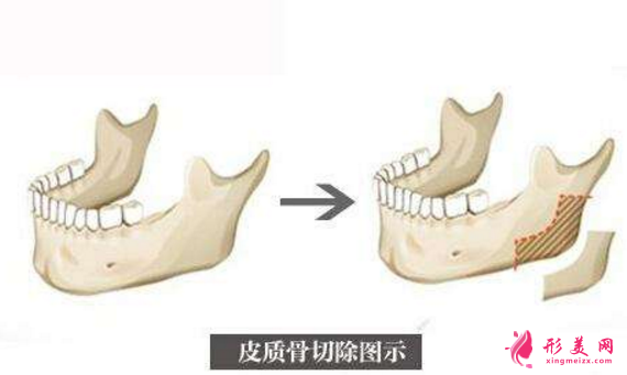 下頜角切除一般多少錢