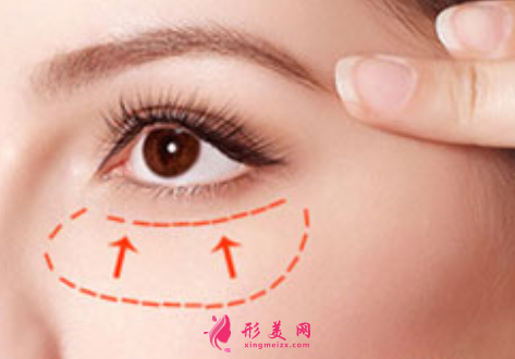 手術(shù)切除眼袋后多久恢復(fù)自然