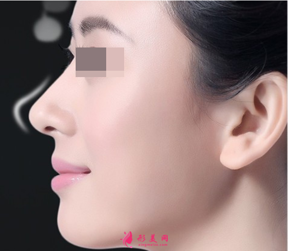肋軟骨隆鼻的效果可以保持多久