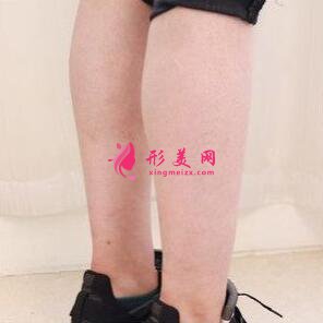 保妥適瘦小腿的術(shù)前注意事項(xiàng)