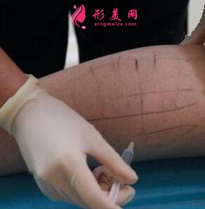 保妥適瘦小腿的優(yōu)勢(shì)