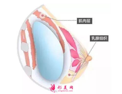 假體隆胸前需要注意的事項