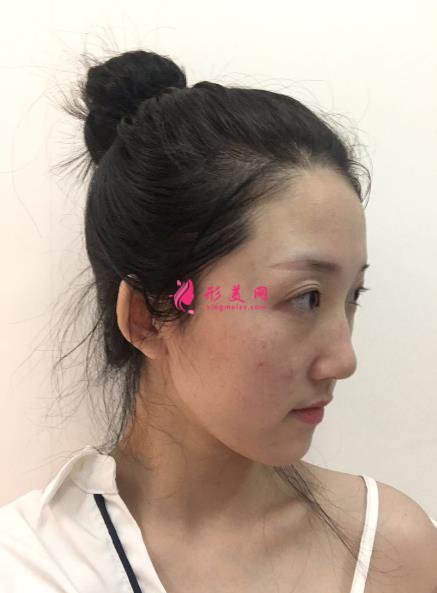 深圳香蜜麗格醫(yī)療美容激光祛斑案例，膚如凝脂~