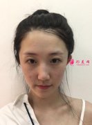 深圳香蜜麗格醫(yī)療美容激光祛斑案例，膚如凝脂~