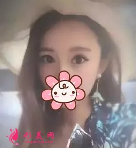 北大深圳李天石雙眼皮案例，無神小眼睛的蛻變記錄！