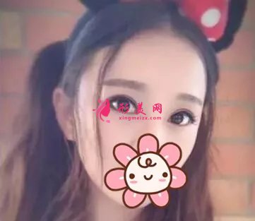 北大深圳李天石雙眼皮案例，無神小眼睛的蛻變記錄！