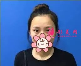 北大深圳李天石雙眼皮案例，無神小眼睛的蛻變記錄！