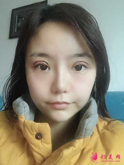 淚干無(wú)息的切開(kāi)雙眼皮術(shù)后即刻照