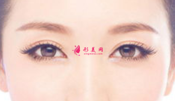 雙眼皮術(shù)后不對稱是怎么回事