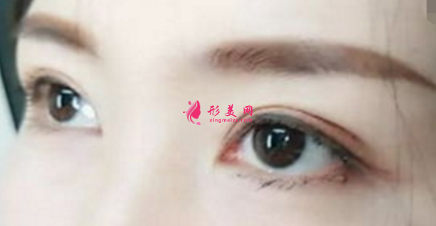 什么樣雙眼皮比較好看